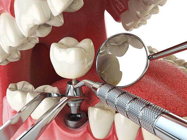 Best Emergency Treatment for Dental Infections or Abscesses in Spokane Valley, WA